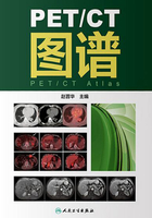 PET/CT图谱