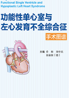 功能性单心室与左心发育不全综合征手术图谱在线阅读