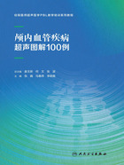 颅内血管疾病超声图解100例在线阅读